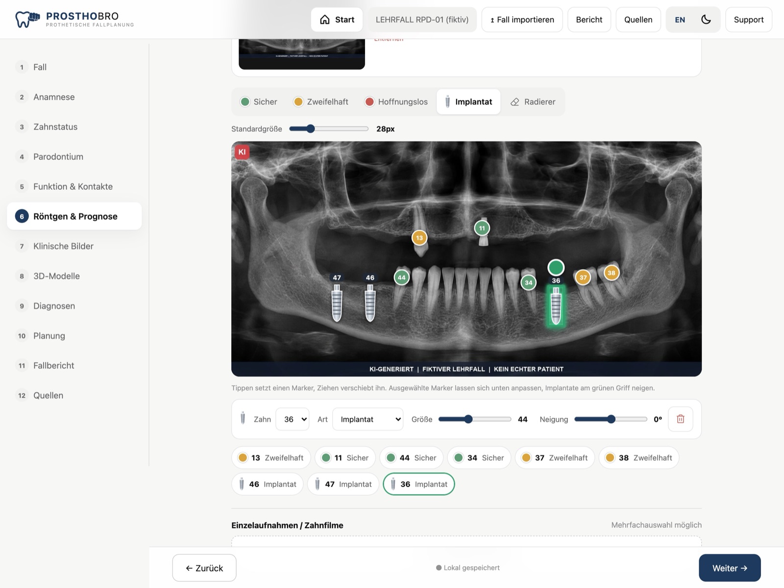 Panoramaröntgenbild eines Lehrfalls mit Prognosepunkten und Implantaten